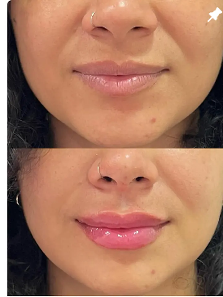 Preenchimento labial