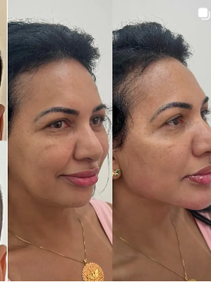 Harmonização facial