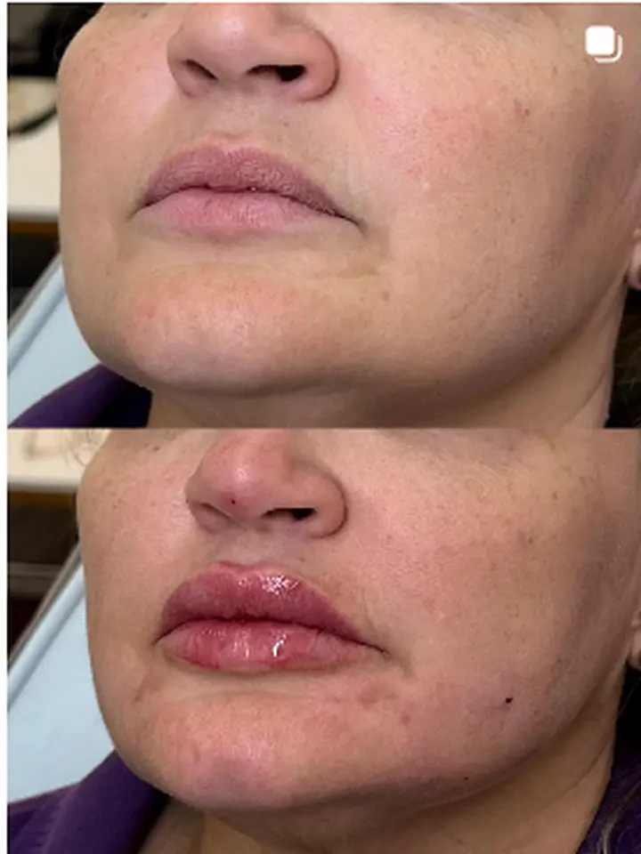 Preenchimento labial